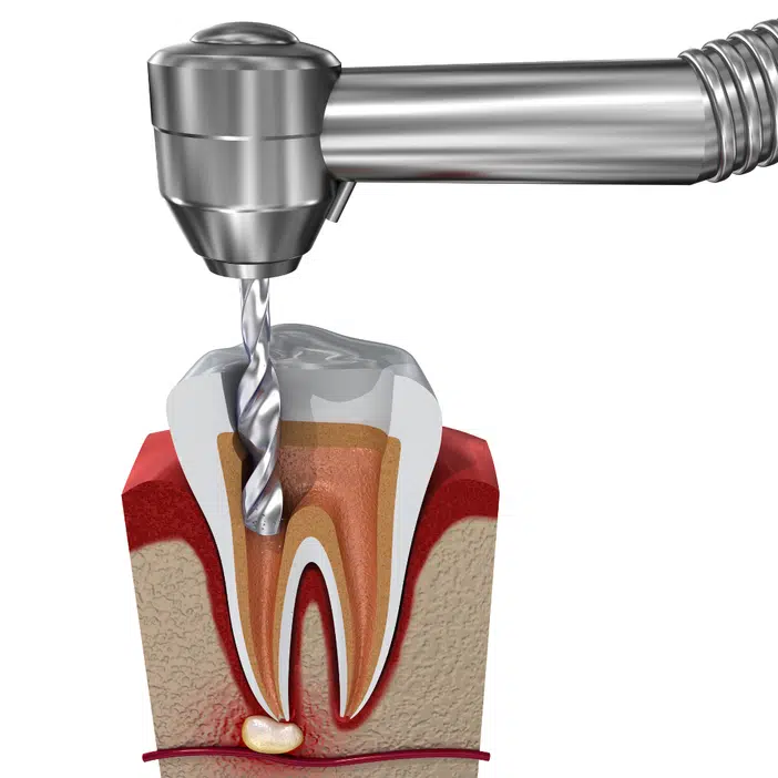 root-canal-dentist-preston
