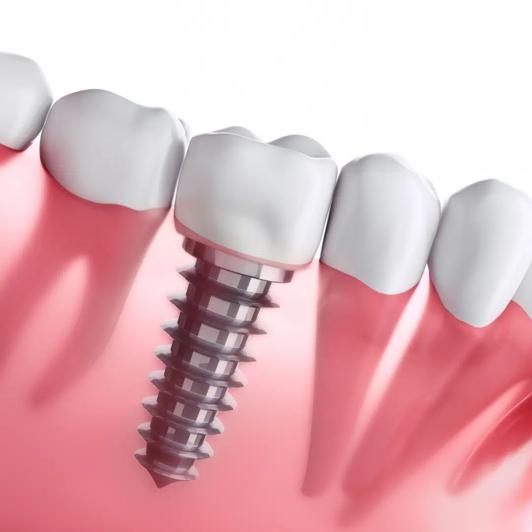 digital-dental-implants