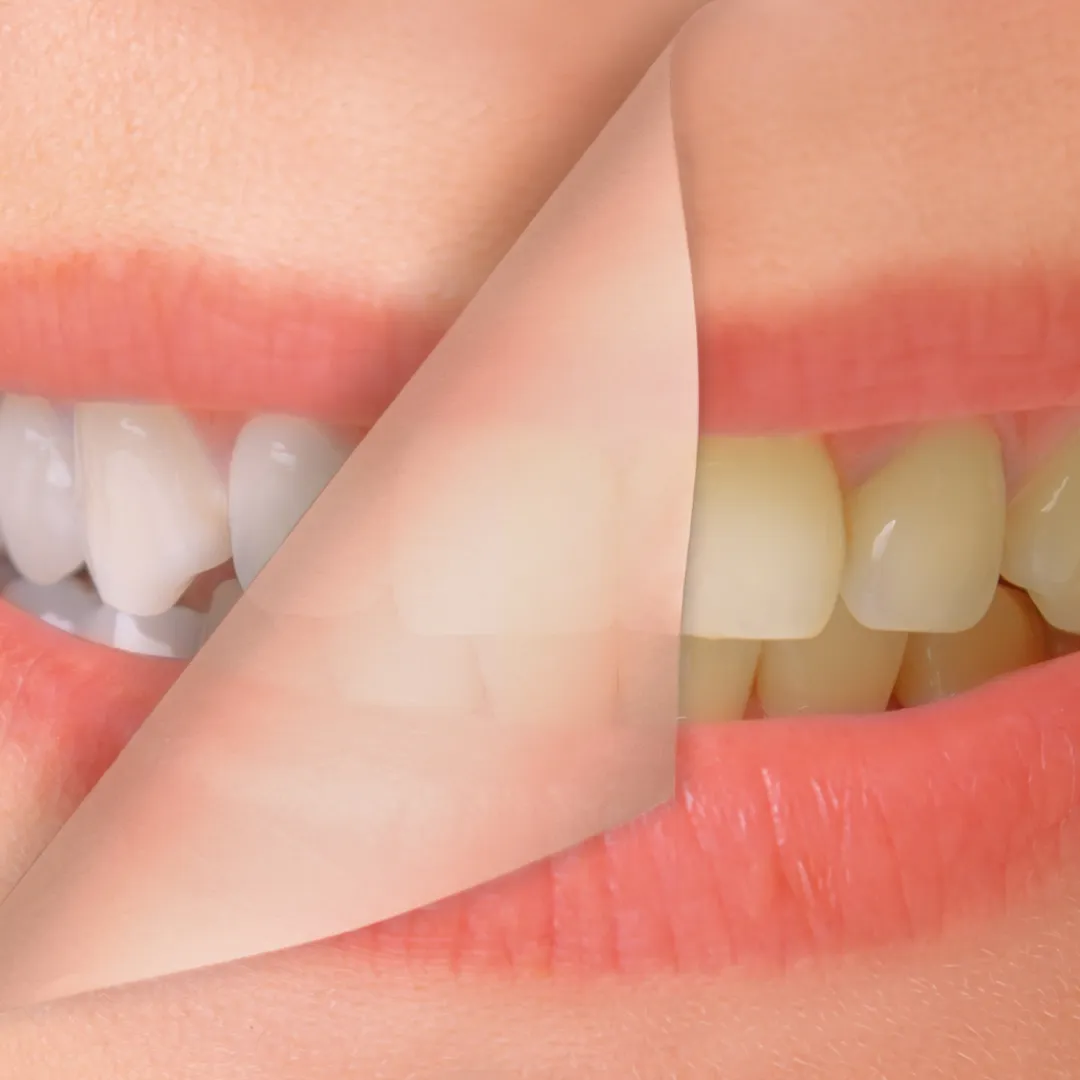 teeth-whitening-BSC