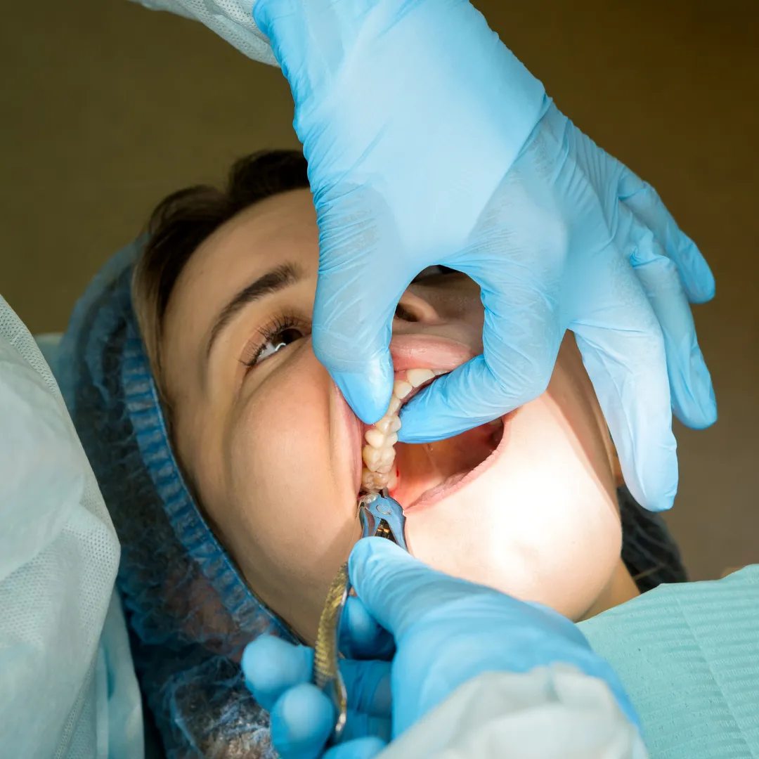 tooth-extraction-BSC