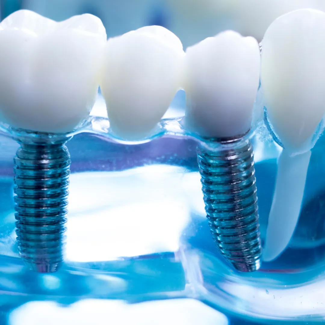dental-implant-BSC
