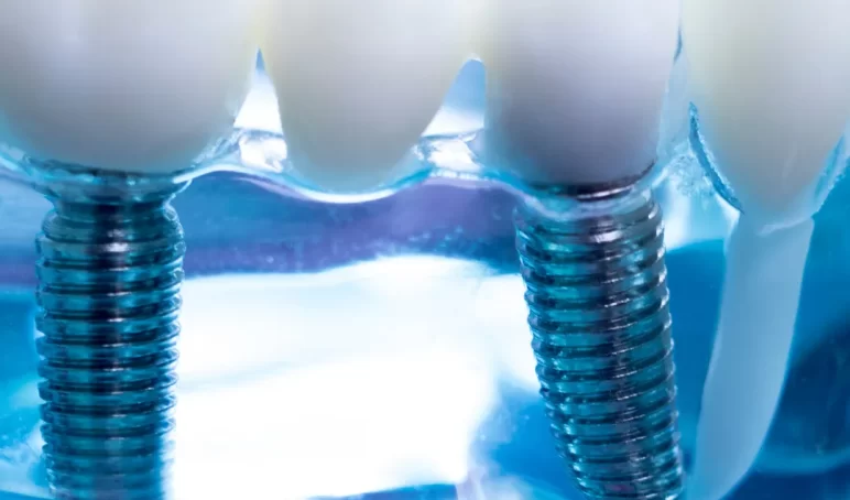 dental-implant-BSC