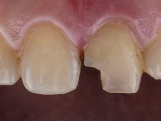 front -teeth-filling-BSC