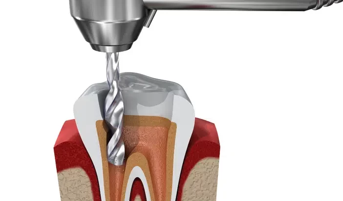 root-canal-dentist-preston