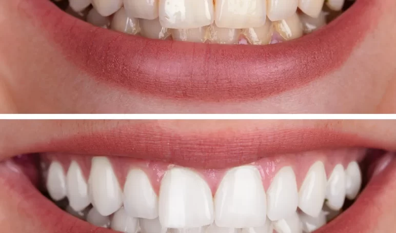 teeth whitening-Preston