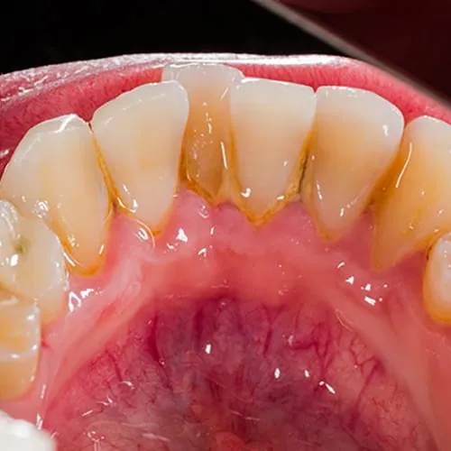 teeth-cleaning-BSC
