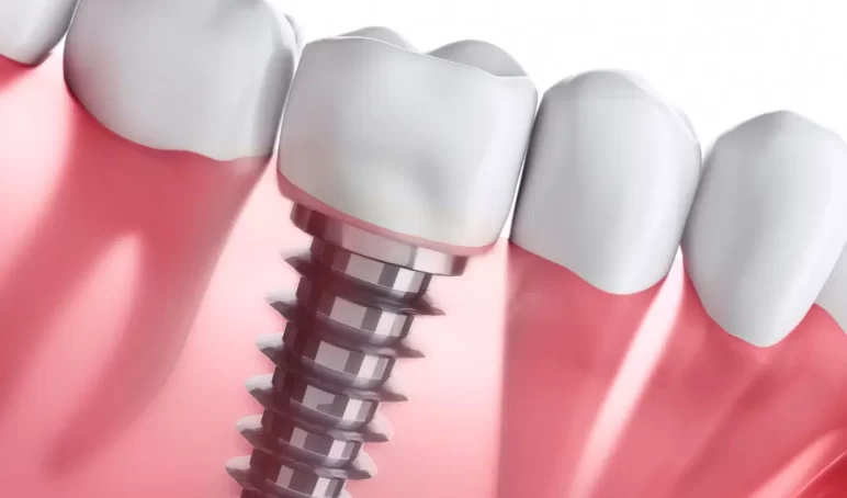 digital-dental-implants