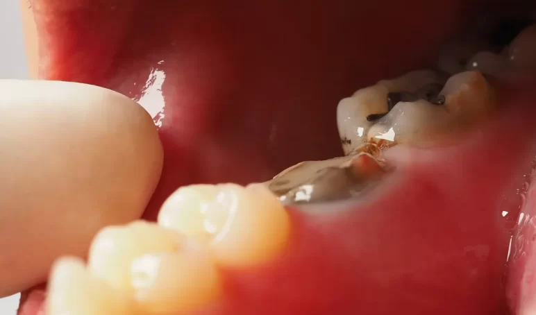 root-canal-BSC