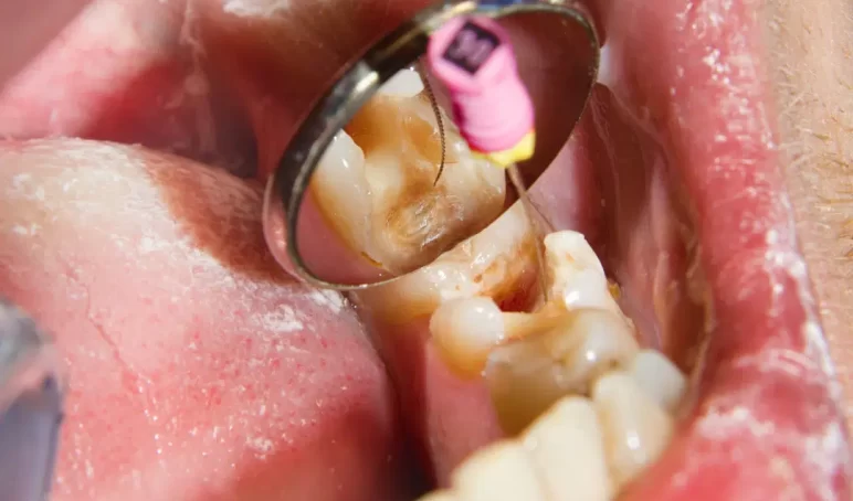 root-canal-infection