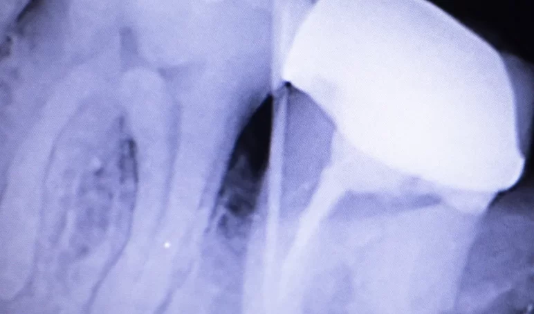 root-canal-taste root-canal-taste