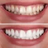 teeth whitening-Preston