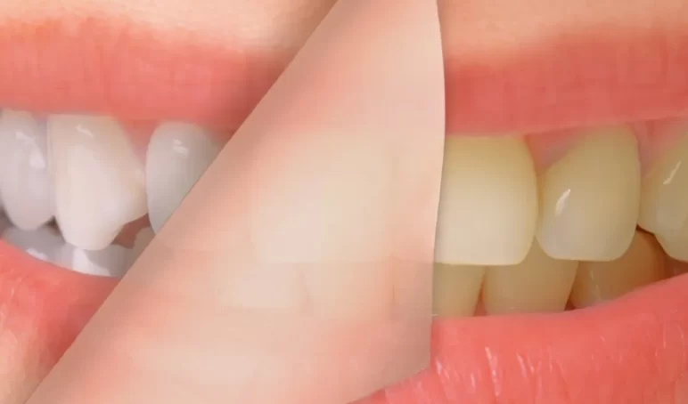 teeth-whitening-BSC