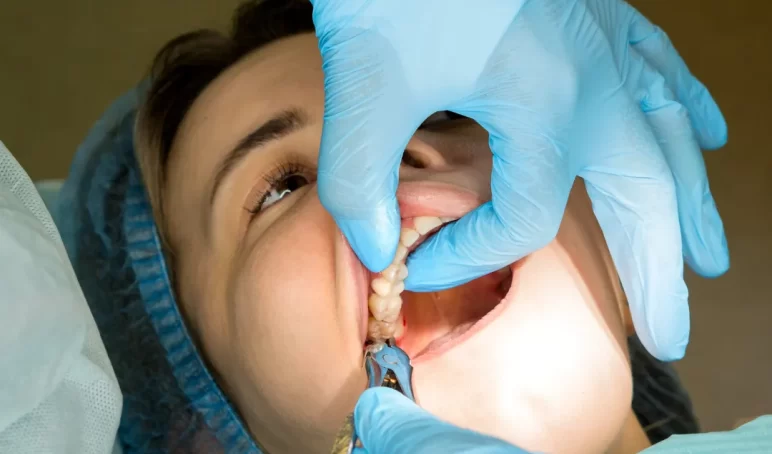 tooth-extraction-BSC